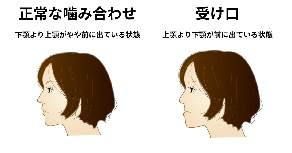 正常咬合と受け口の違い