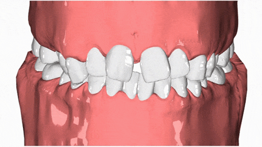 歯科矯正の3Dモデル