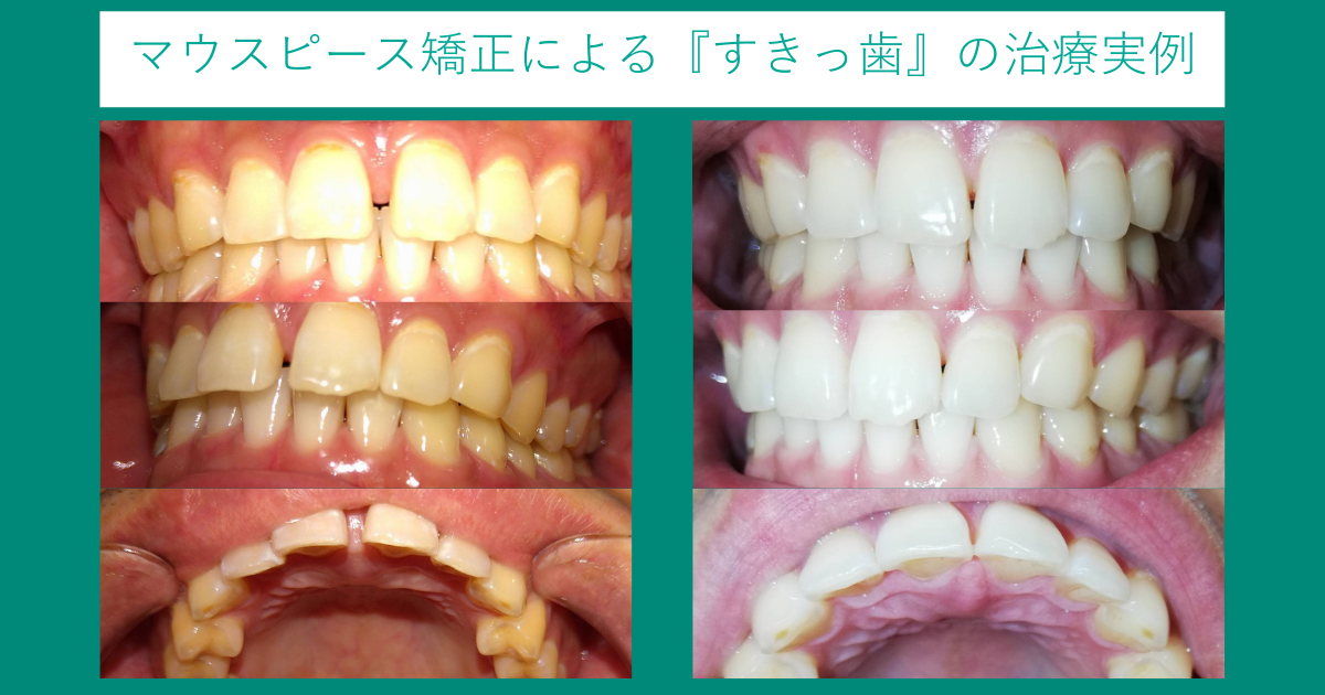 マウスピース矯正には保険適用される 費用や適用されるケースを紹介 Hanaravi歯科矯正blog