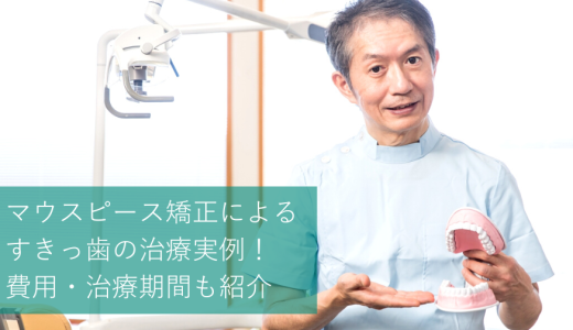 すきっ歯を矯正で治す！マウスピース矯正によるすきっ歯の治療例・費用・期間を紹介