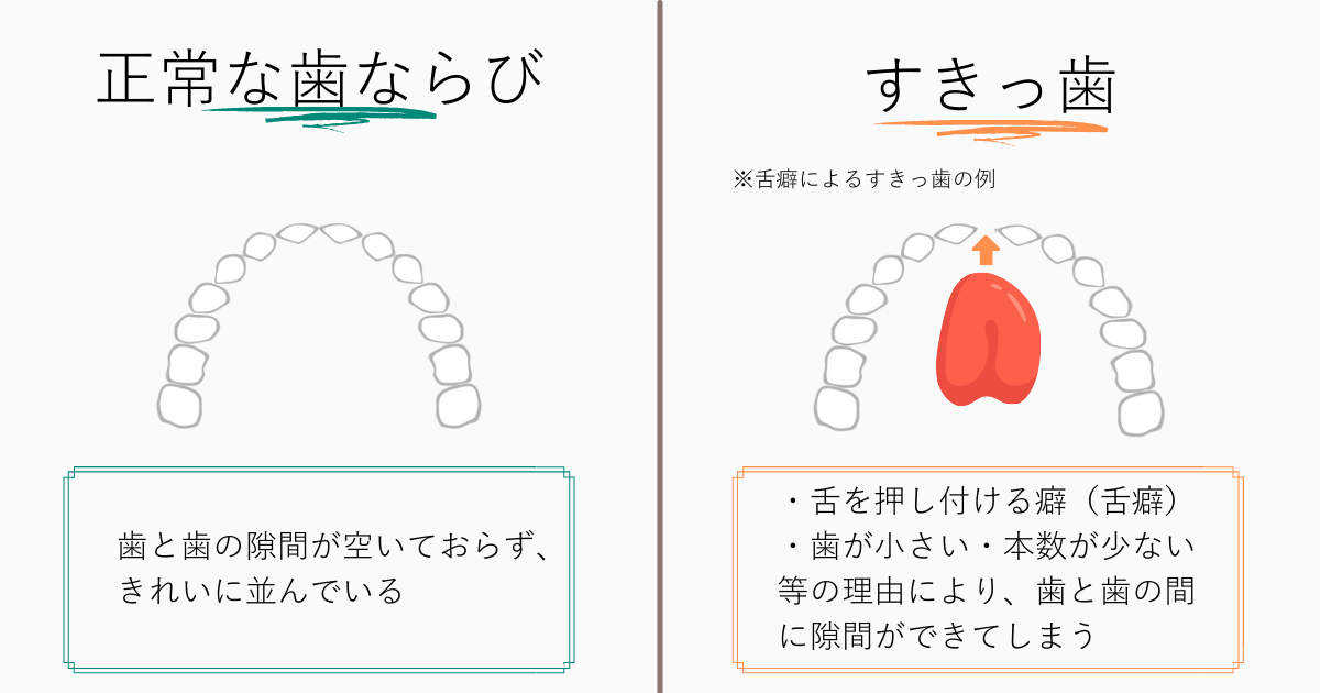 すきっ歯の仕組み