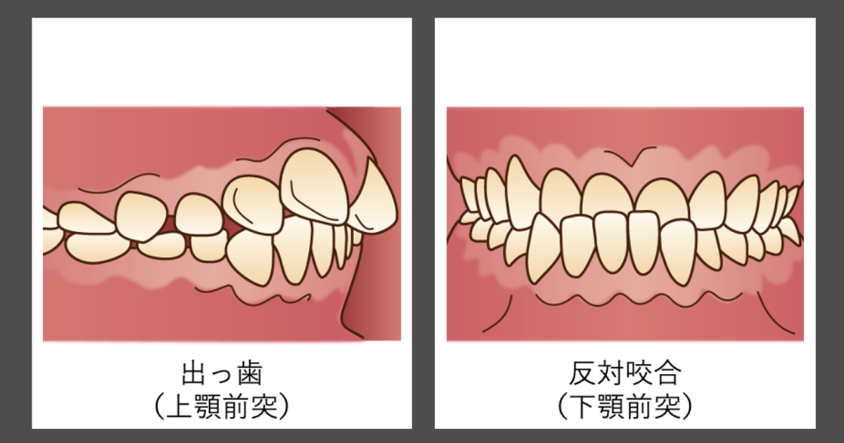 抜歯　噛み合わせ