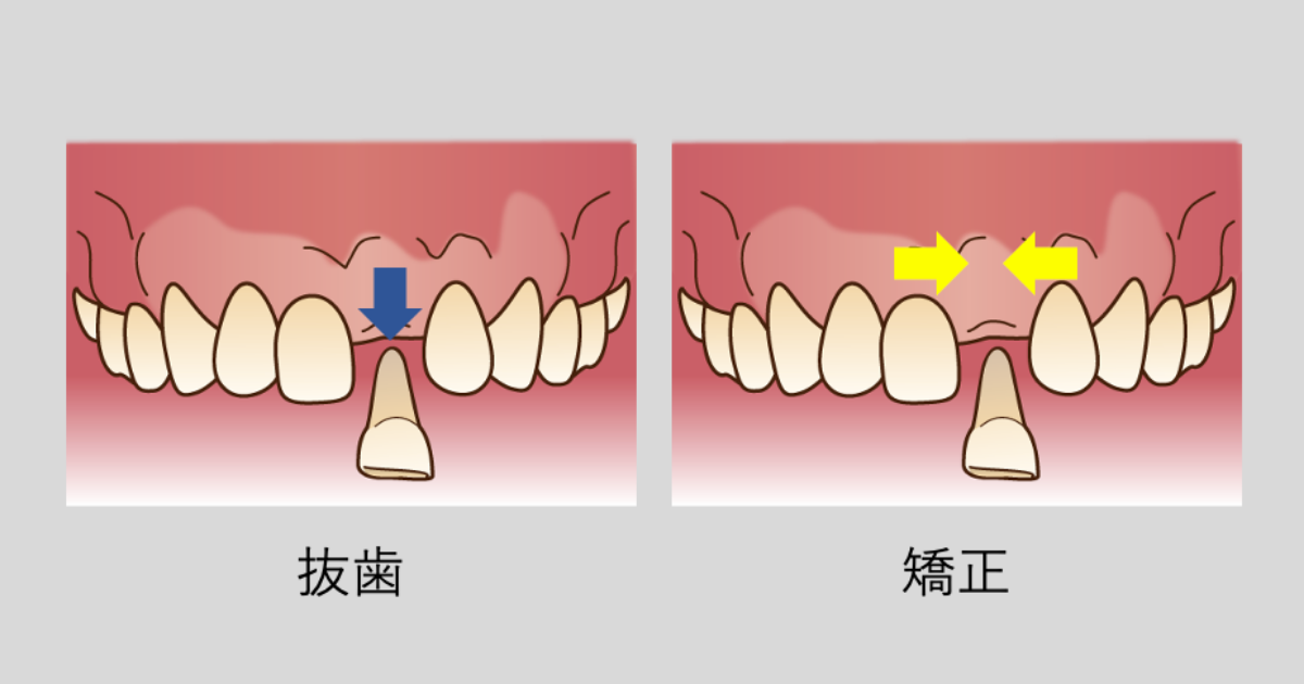 抜歯　矯正