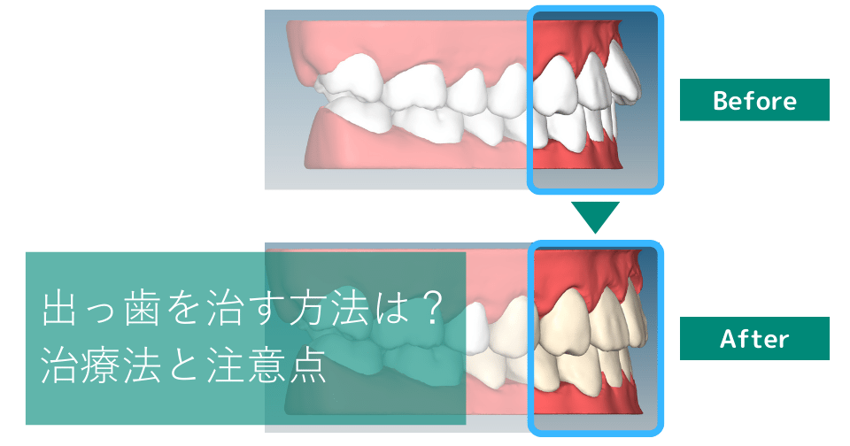 出っ歯を治す方法は？5つの歯列矯正の方法や治療を受けたあとの注意点