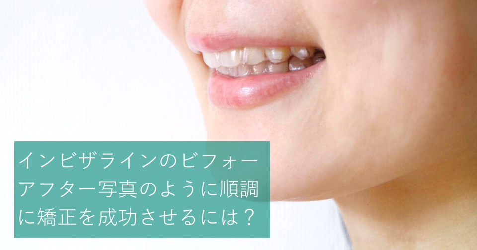 インビザラインのビフォーアフター写真のように順調に矯正を成功させるには Hanaravi歯科矯正blog