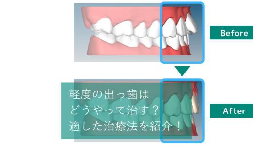 軽度の出っ歯の基準・治し方は？費用感や自力で治す方法についても解説