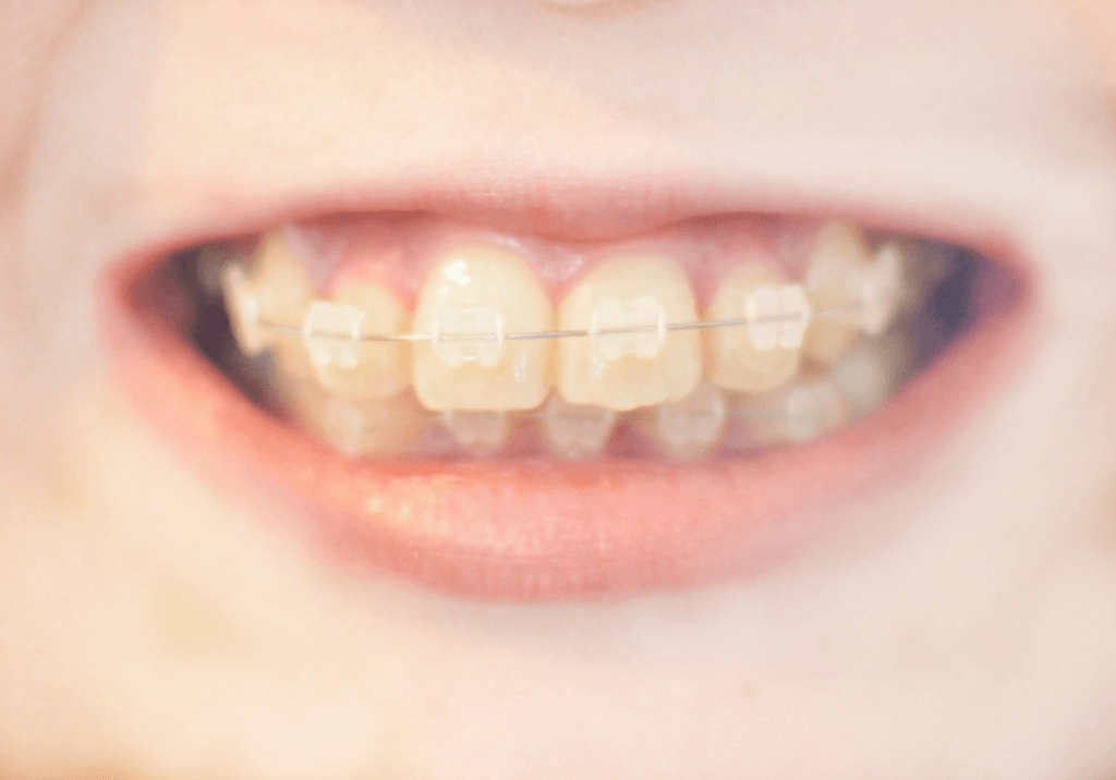 出っ歯の種類は2種類！多くの人が悩む不正咬合の治し方とは？