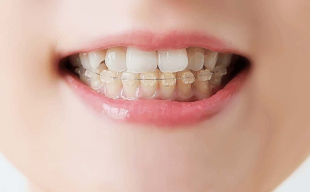 下の歯の部分矯正はできる？部分矯正の方法や適応症例について詳しく解説！