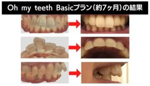 Oh my teethとキレイラインの違いは？通院の有無や提携クリニックなど解説 