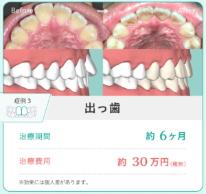 矯正で歯並びはどうなる？大人の費用や種類、やめた方がいい場合も解説 