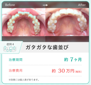 矯正で歯並びはどうなる？大人の費用や種類、やめた方がいい場合も解説 