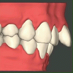 歯が動くシミュレーションのGIF画像