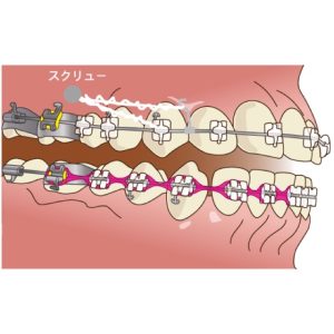 【大人の歯列矯正】治療期間を短くするコツは？治療方法ごとの期間も解説 