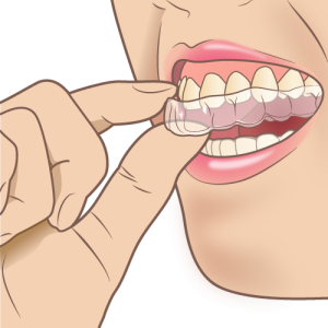 【大人の歯列矯正】治療期間を短くするコツは？治療方法ごとの期間も解説 
