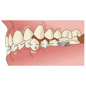歯科矯正でよくある7つの失敗事例！防ぐ方法と失敗後の対応も解説！