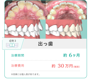 前歯のみの部分矯正とは？矯正方法とメリット・デメリットを解説！