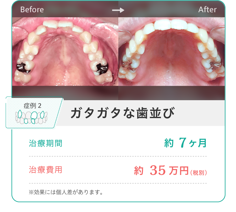 ガタついた歯並びの矯正イメージ画像。治療期間の目安は7カ月で、費用は約35万円でした。ただし、効果には個人差があります。