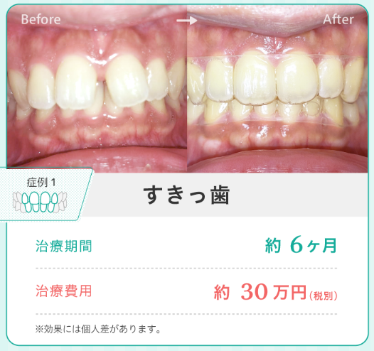 すきっ歯の矯正イメージ画像。治療期間の目安は6カ月で、費用は約30万円でした。ただし、効果には個人差があります。
