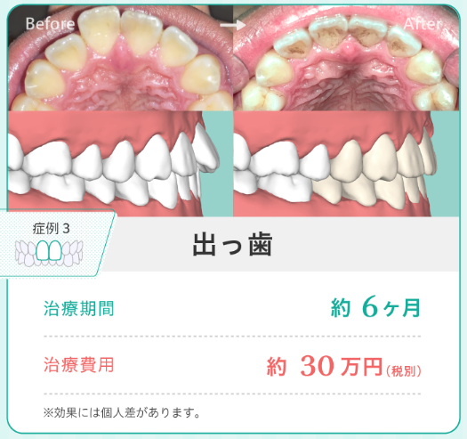 出っ歯のの矯正イメージ画像。治療期間の目安は6カ月で、費用は約30万円でした。ただし、効果には個人差があります。