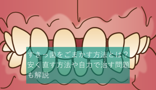 すきっ歯をごまかす方法とは？安く直す方法や自力で治す問題も解説