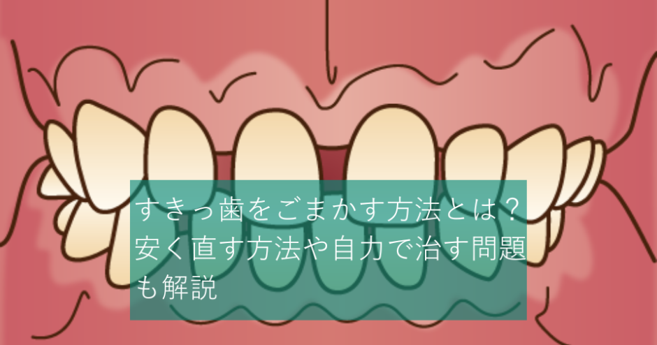 すきっ歯をごまかす方法とは？安く直す方法や自力で治す問題も解説