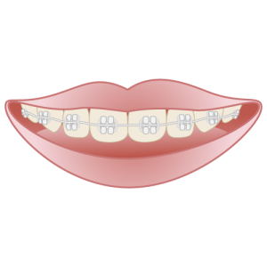 なぜ歯並びは良いけど口ゴボになるのか？その原因や治療法を解説します