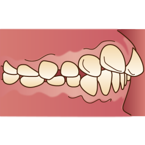 出っ歯のイメージ画像。歯が前に出ていると前歯が大きく見えやすいです。