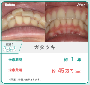 hanaraviによるガタツキのある歯の症例。ガタツキのある歯並びが綺麗に並びました。治療期間は約1年で、治療費用は約45万円です。※効果には個人差があります。