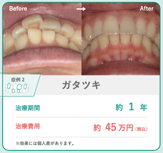 hanaravi矯正によるガタツキのある歯の症例写真。ガタガタの歯並びが、綺麗に揃いました。治療期間は約1年で、治療費用は約45万円です。※効果には個人差があります。