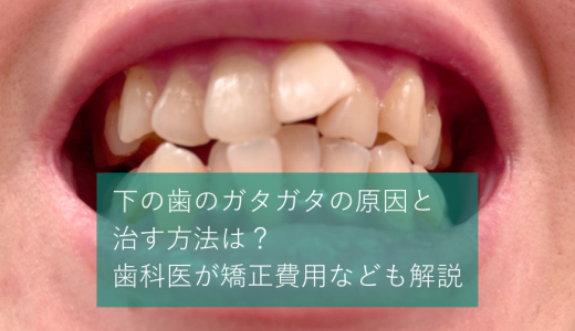 下の歯のガタガタの原因と治す方法は？歯科医が矯正費用なども解説