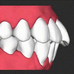 hanaraviの精密検査で用いる3Dシミュレーションのイメージ画像。マウスピース矯正によって出っ歯の歯が動き、美しい歯並びへと整っていく様子を視覚的に理解することができる。