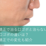 矯正で治る口ゴボと治らない口ゴボの違いは？矯正での変化も紹介