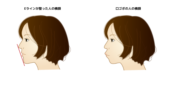 Eラインが整った人と口ゴボの人の横顔のイラスト。前者は鼻と口を結んだ線の中に唇が収まっているが、口ゴボの人は口元が突出している。