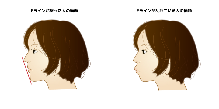 Eラインが整った顔の人とそうではない人の比較画像