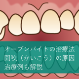 オープンバイトの治療法｜開咬（かいこう）の原因・治療例も解説