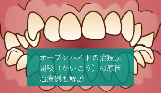 オープンバイトの治療法｜開咬（かいこう）の原因・矯正例も解説