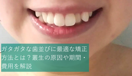 ガタガタな歯並びの原因・治療法は？治療期間や費用、疑問なども解説