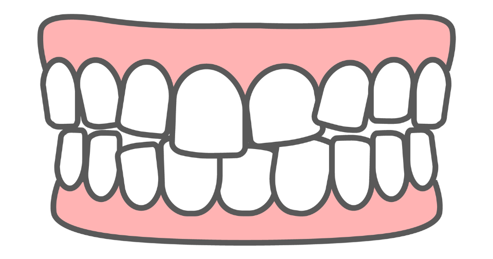 軽い叢生・ガタツキ・凸凹の歯並び