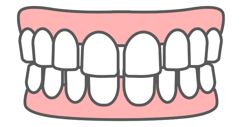 すきっ歯・空隙歯列のイメージ図