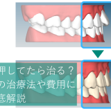 出っ歯は押してたら治る？おすすめの治療法や費用について徹底解説