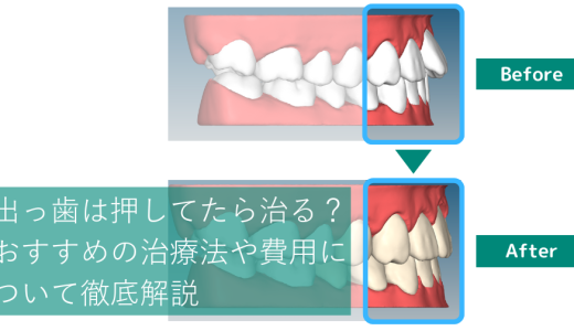 出っ歯は押してたら治る？そのリスクや治療法、費用について徹底解説