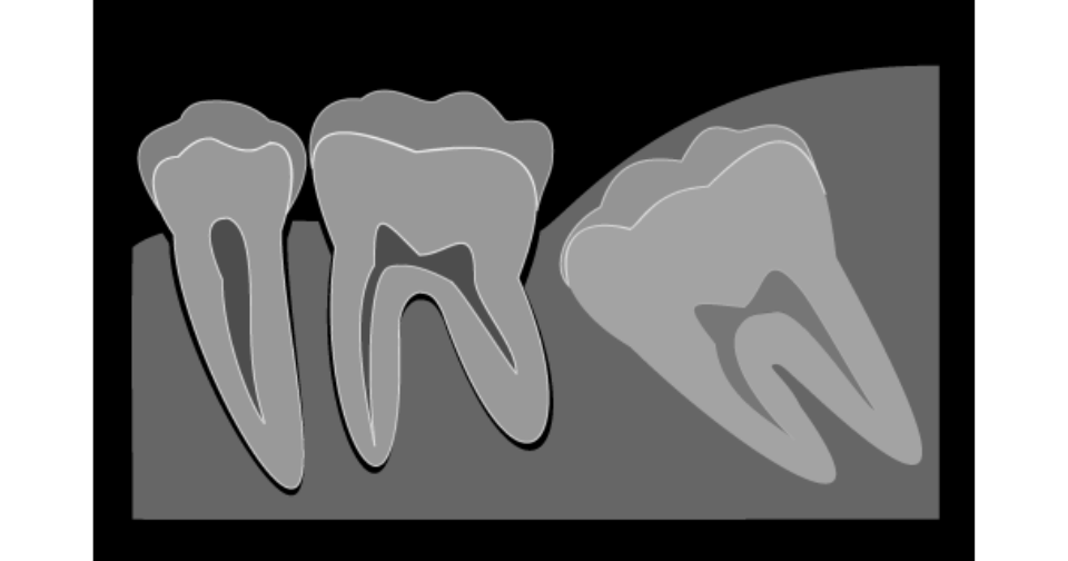 埋まっている親知らずが歯並びに影響を与えているイメージ図