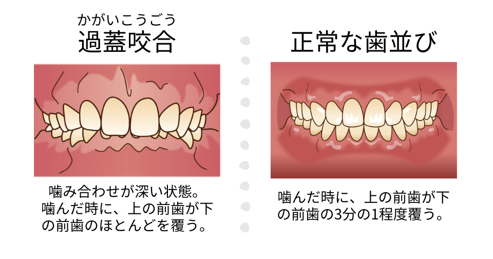 過蓋咬合と正常な咬合の比較