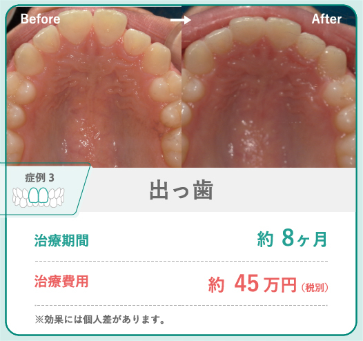 抜歯矯正で口元が引っ込みすぎる理由は？予防法を医師が解説 | hanaravi歯科矯正blog