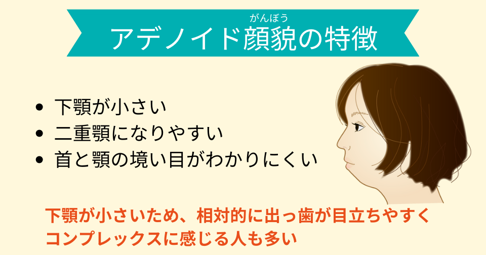 アデノイド顔貌の特徴