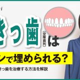 すきっ歯（空隙歯列）はレジンで埋められる？手軽にすきっ歯を治療する方法を解説