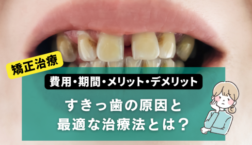 すきっ歯の原因と最適な治療法とは？費用・期間・メリット・デメリットを解説