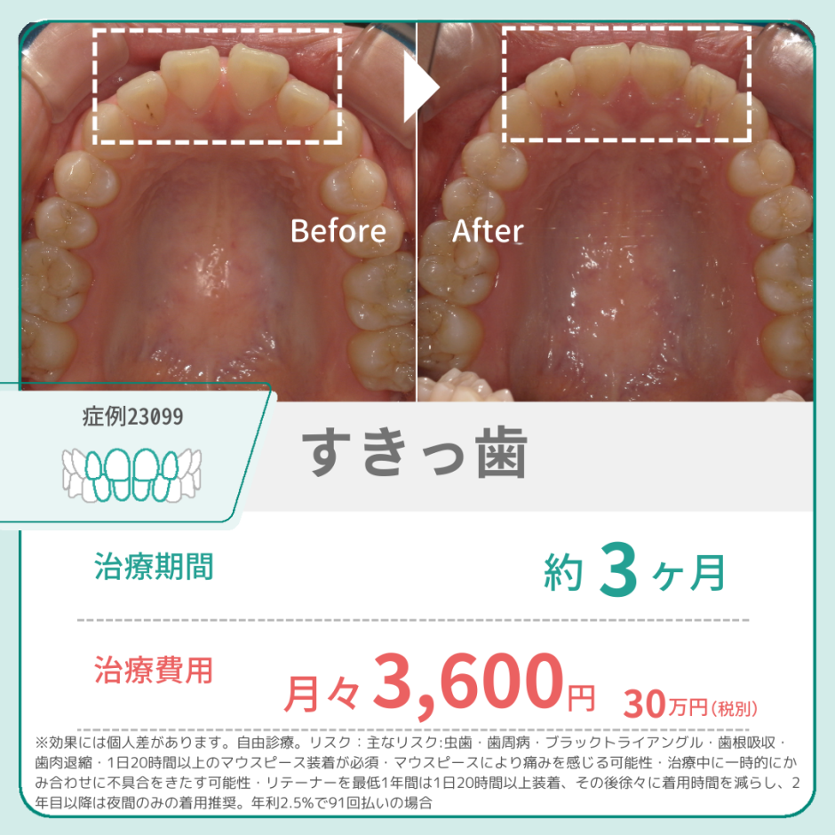 部分矯正の値段の相場は?一本だけ・前歯だけなど種類別に解説 | hanaravi歯科矯正blog