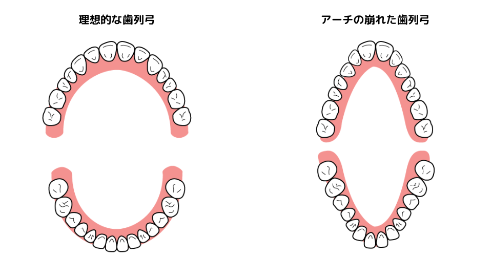 理想的な歯列弓とアーチが崩れた歯列弓