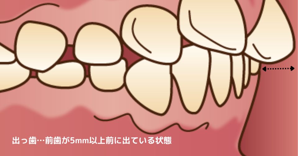 出っ歯の基準についての画像。前歯が5㎜以上前に出ている状態を出っ歯と呼ぶことが多い。